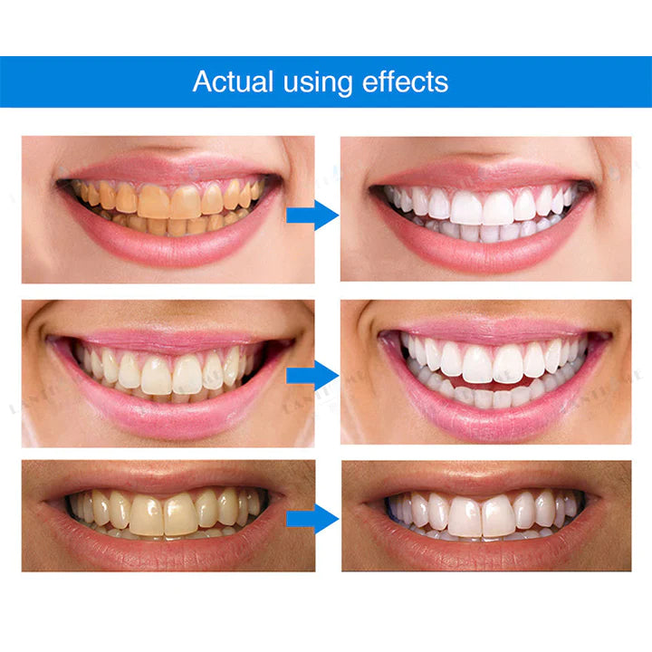 Lanthome™ Teeth Whitening Essence